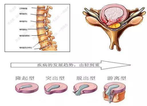 腰疼腿麻下肢无力你得腰椎间盘突出了吗